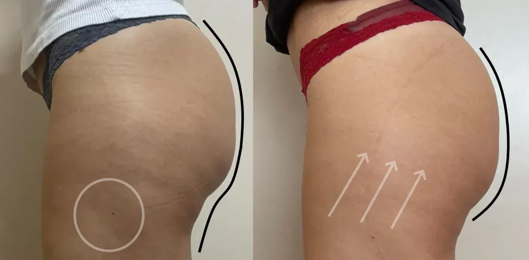 Mejoría de la celulitis en piernas y glúteos tratada con Accent Prime, antes y después