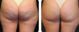 Abordaje y manejo de celulitis