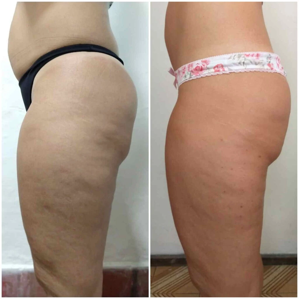 ¿Cómo Combatir la Celulitis?