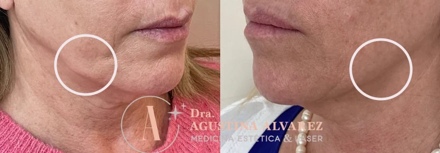 Mejoría del óvalo facial y la papada tratada con Accent Prime, antes y después