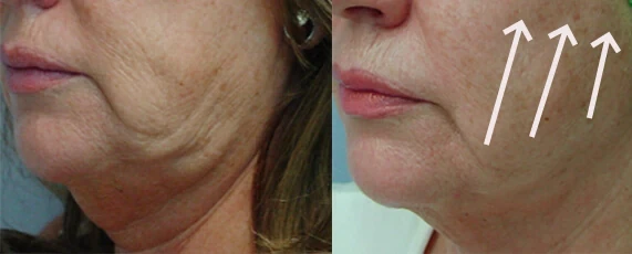 ¿Se te esta cayendo la cara? Como Mejorar la flacidez facial.