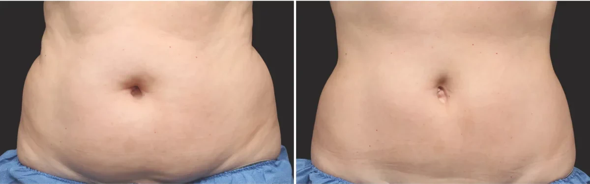 Localized fat treatment planning