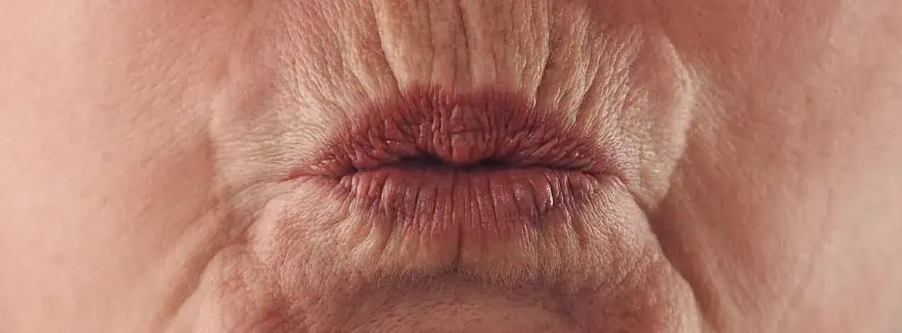 Lip lines concern assessment
