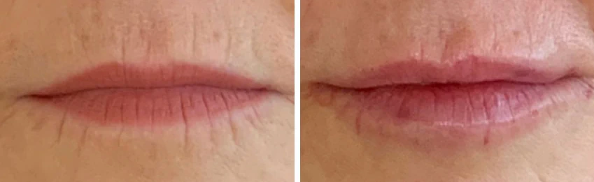 Lip lines treatment planning