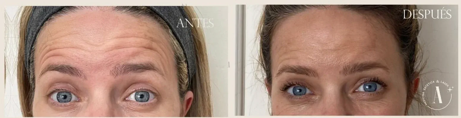 Forehead lines concern assessment