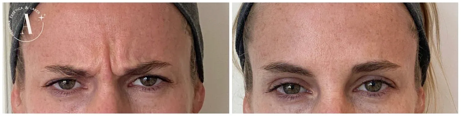 Treatment option for facial lines