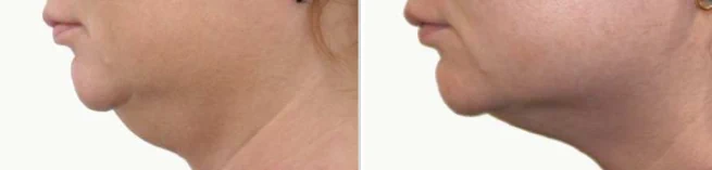 Under-chin fullness treatment planning