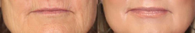 Thin lips treatment planning