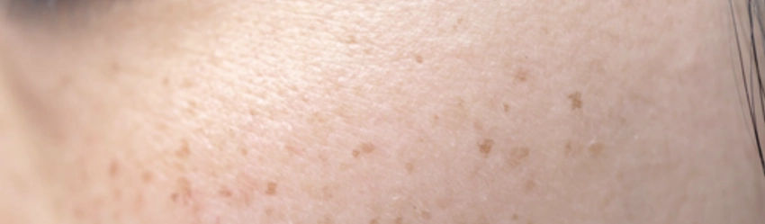Sun spots concern assessment