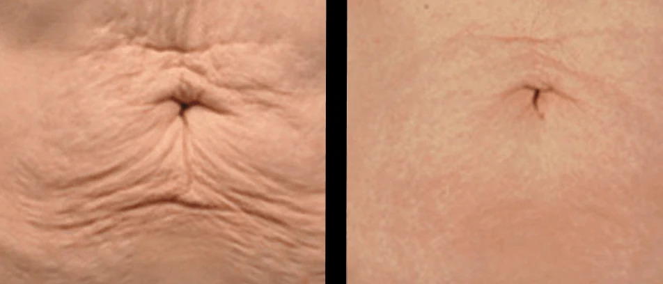 Body laxity treatment planning