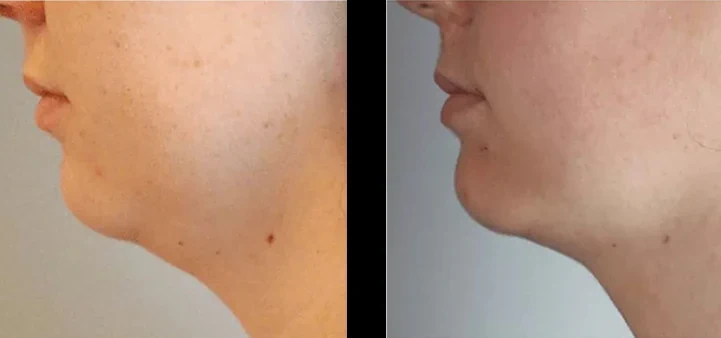 Under-chin fullness concern assessment