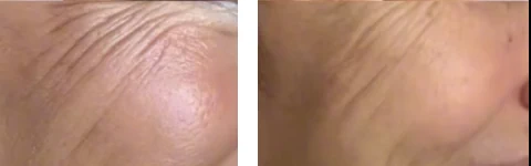 Crow's feet concern assessment