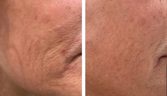 Facial aging treatment planning