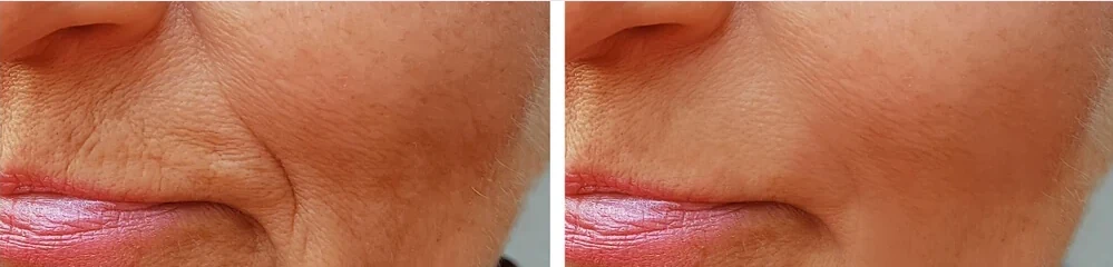 Radiesse as an option for facial support and lines