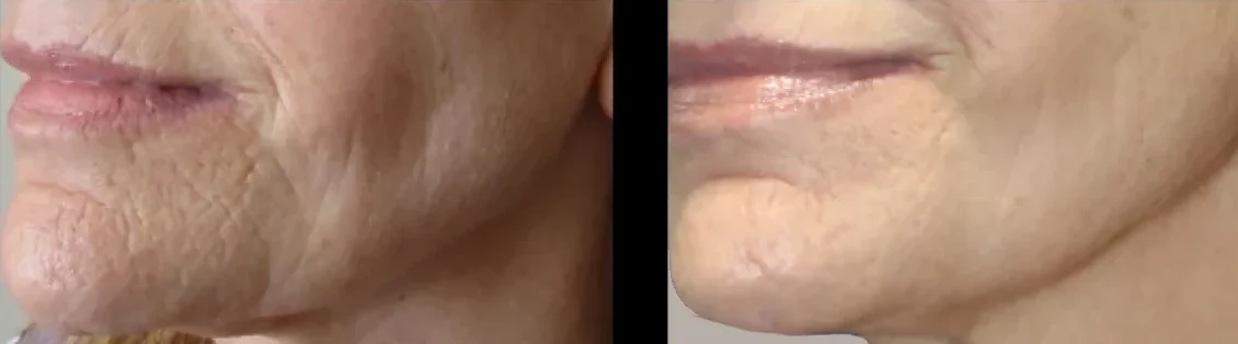Treatment option for facial lines