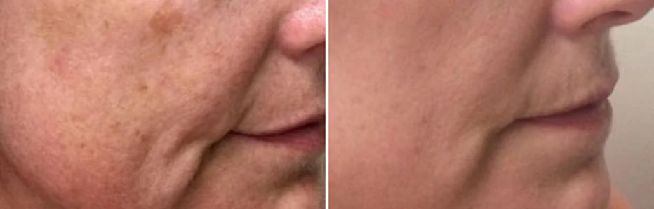 Facial aging concern assessment