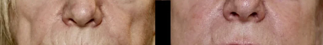Treatment option for facial lines
