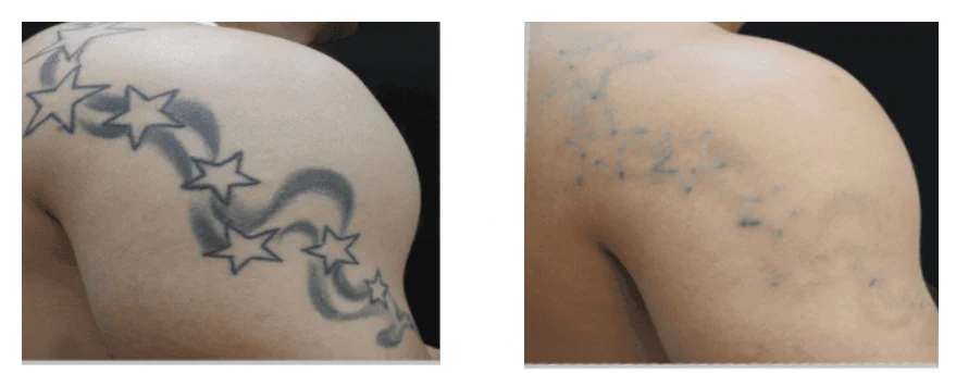 Tattoo removal concern assessment