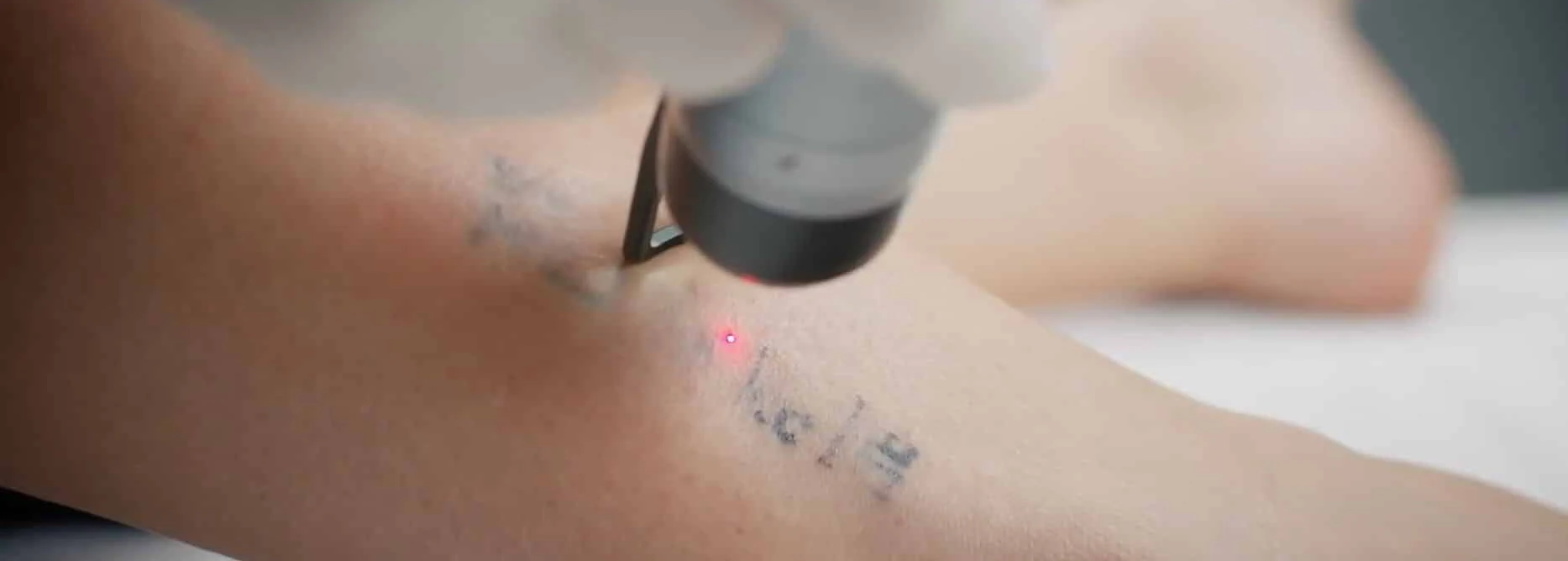 Tattoo removal treatment planning