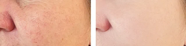 Patient with rosacea-prone skin and redness assessment