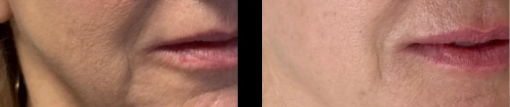 Treatment option for facial lines