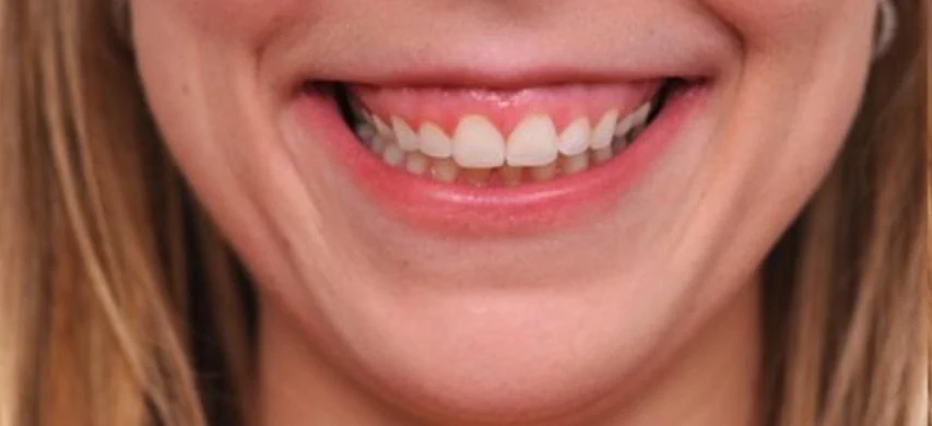 Gummy smile concern assessment
