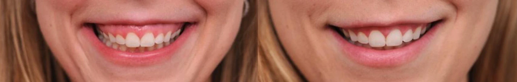 Gummy smile treatment planning
