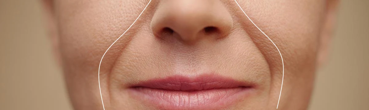Nasolabial folds concern assessment