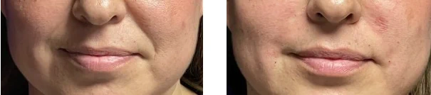 Nasolabial folds treatment planning