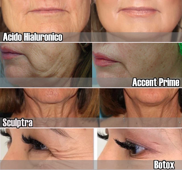 Tratamientos para el envejecimiento facial