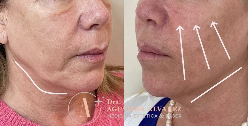 Resultados de tratamiento para flacidez facial