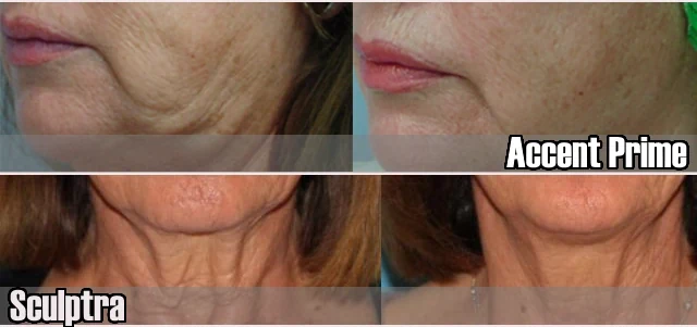 Resultados de tratamiento para jowls