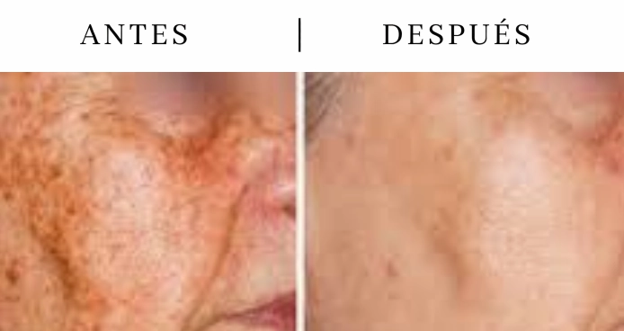 Léntigos solares en la piel tratamiento laser Q-Switch