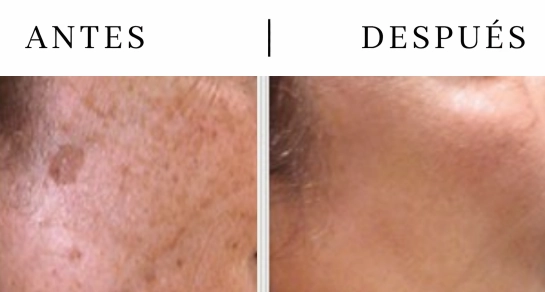 Tratamientos para léntigos