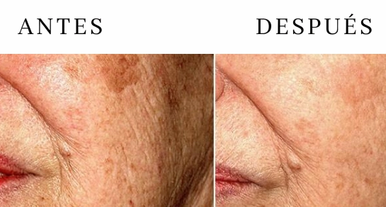 Resultados tratamiento léntigos