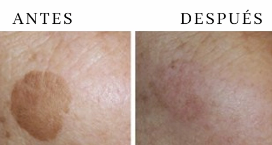 Láser Q-Switch para léntigos