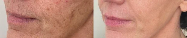 Resultados del tratamiento IPL en manchas
