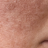 Melasma