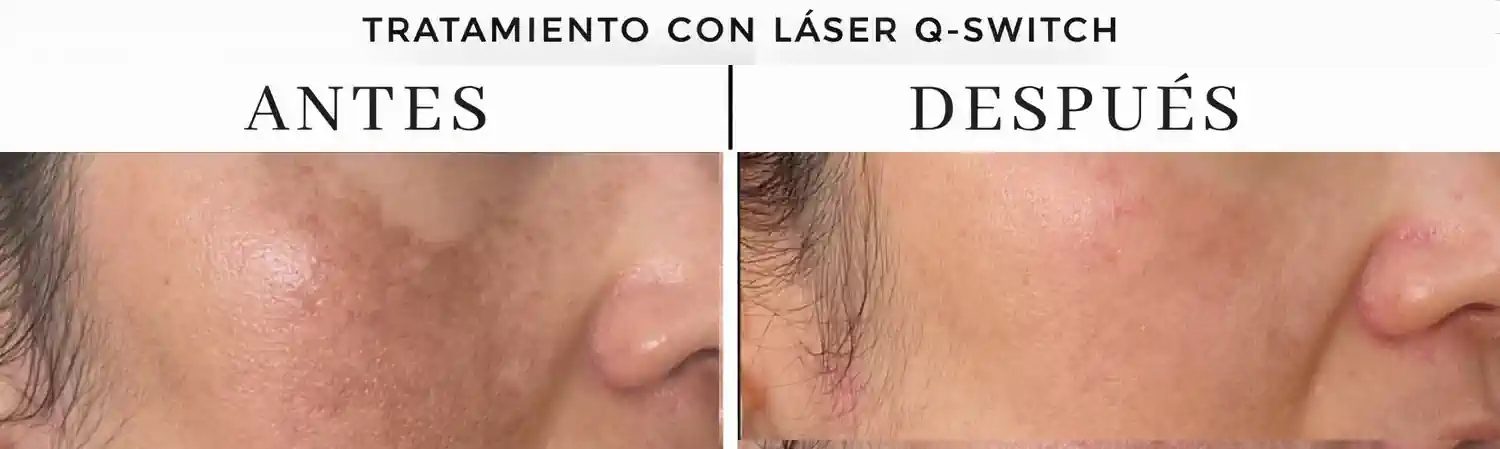 Melasma en la piel tratamiento laser q-switch Buenos Aires