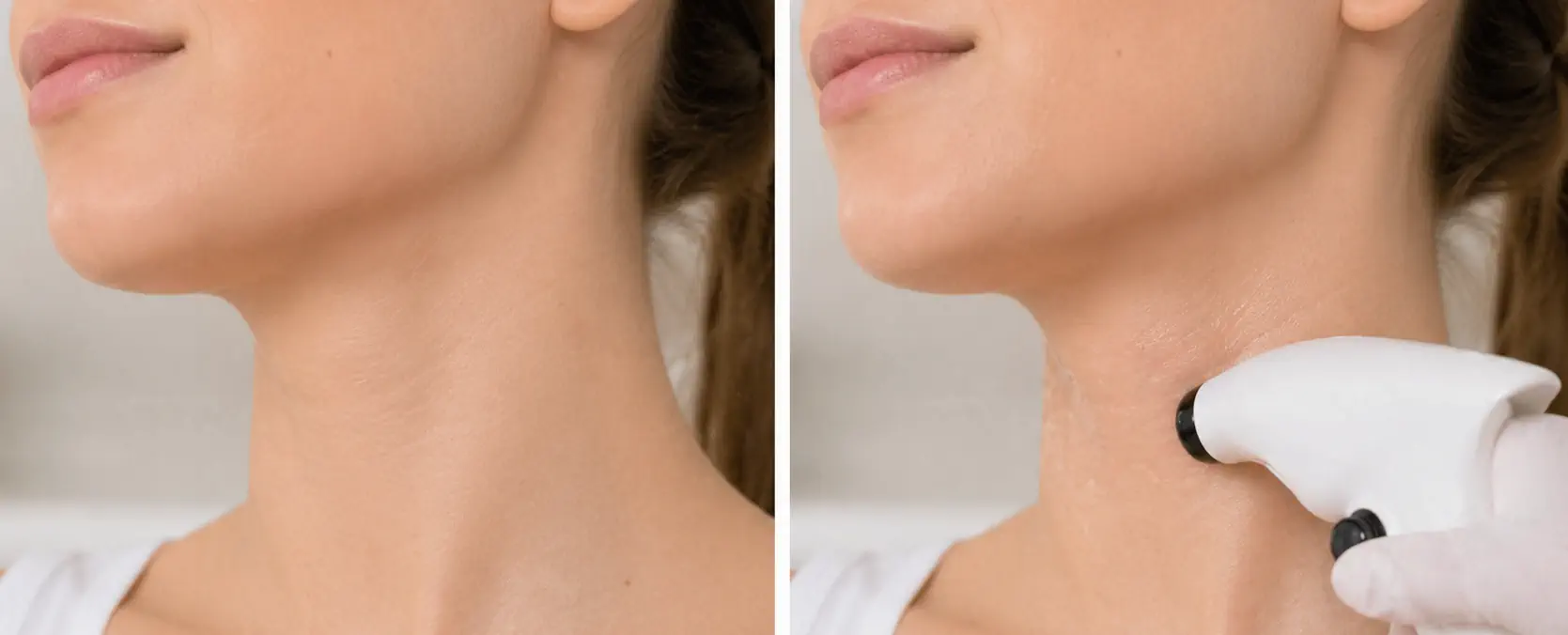 Radiofrecuencia para cuello