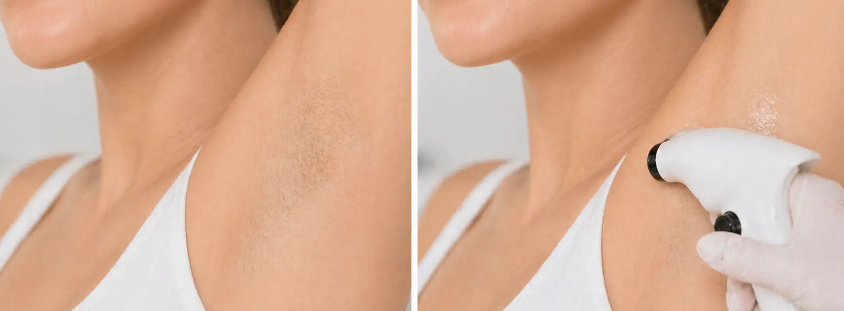 Radiofrecuencia para hiperhidrosis