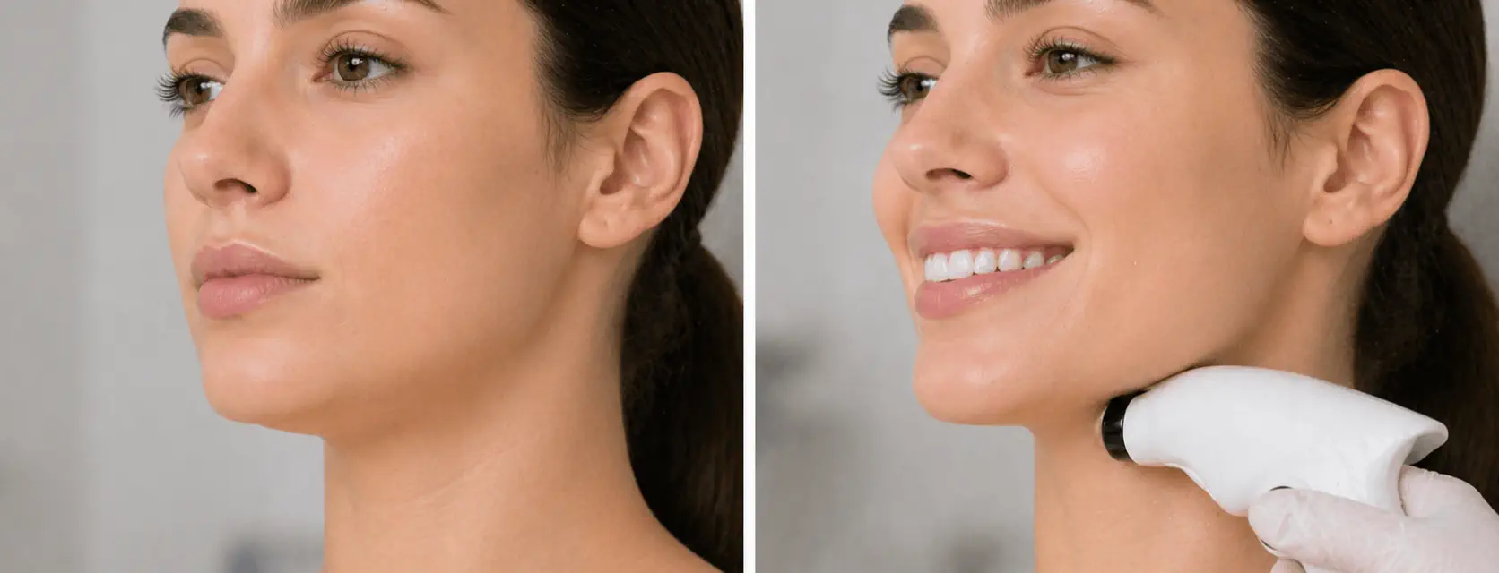 Radiofrecuencia para papada