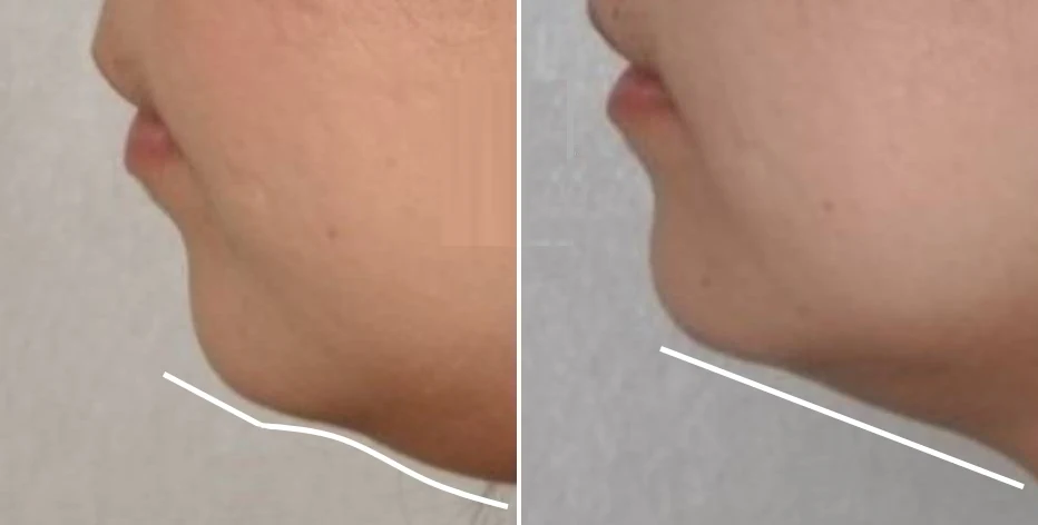 Procedimiento de tratamiento con enzimas PB Serum