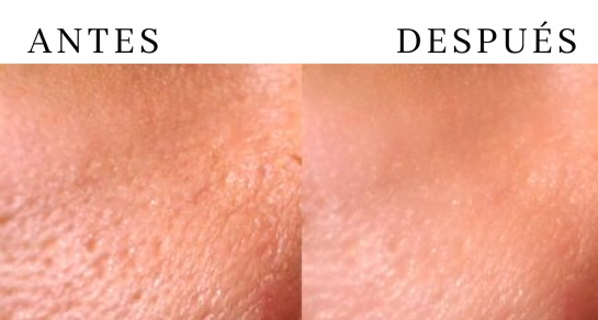 Poros dilatados en la piel tratamiento Buenos Aires