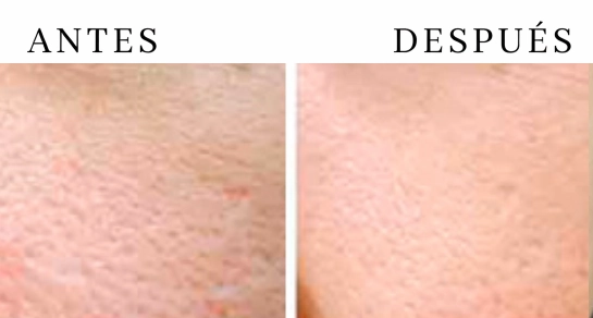 Láser Q-Switch para poros dilatados