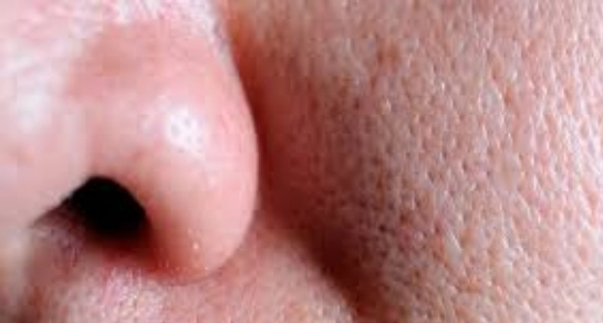 Tratamientos para poros dilatados