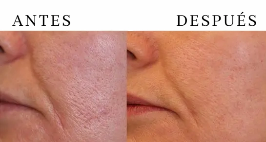 Resultados del tratamiento para poros dilatados