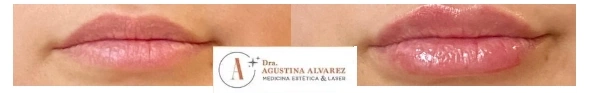 Antes y después de un relleno de labios con ácido hialurónico