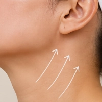 Sculptra Cuello