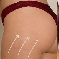 Sculptra Gluteos